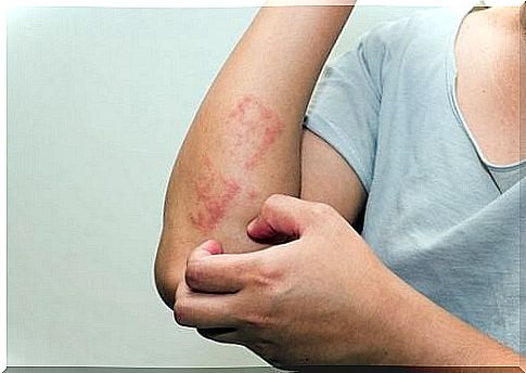 Psoriasis is sometimes difficult to identify.